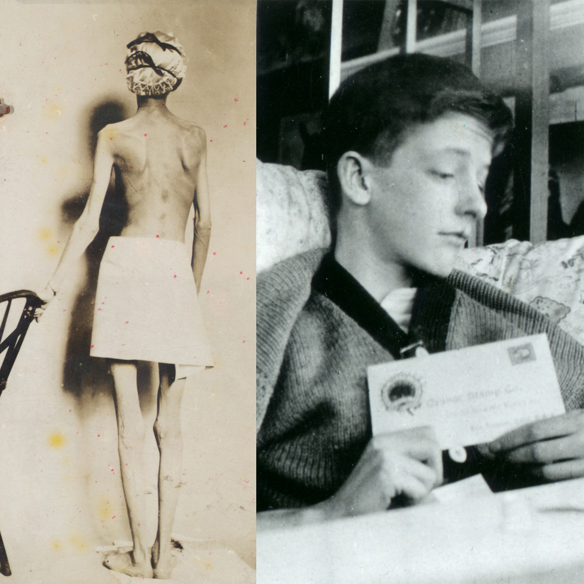 Left: Mrs. Doyle, a diabetic patient, photograph shows back view. Right: Jim Havens sitting up in bed holding a letter.